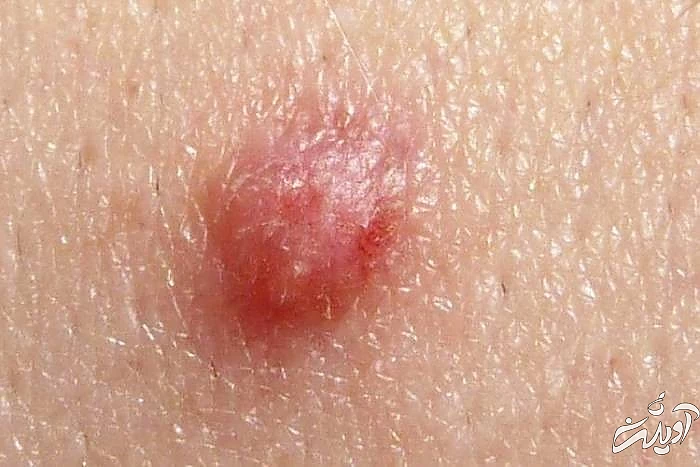 زگیل تناسلی از علائم ابتلا به ایدز زگیل تناسلی